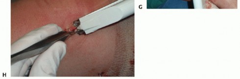 Illustration 35 for Painful Talus Lesions? The tech fig c Osteochondral Transfer Solution