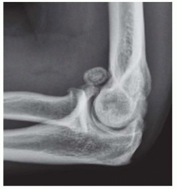 Total Elbow Arthroplasty for Primary Osteoarthritis