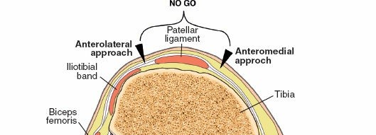 Illustration 2 for Surgical Access: Mastering the Tibia's Surface & Fibula Approaches