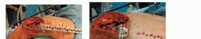 Illustration 55 for Repairing Distal Femur Fractures: Open Reduction & Internal Fixation