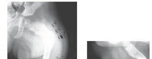 Illustration 9 for Less Pain, More Function: Fassier-Duval Nailing for Osteogenesis Imperfecta