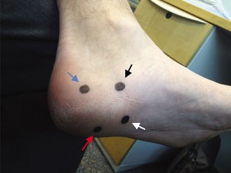 Illustration 2 for Unraveling Heel Pain: Diagnosing Lateral Plantar Nerve Entrapment