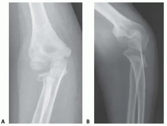 صورة توضيحية لـ دليلك الشامل لكسور رأس وعنق الكعبرة: التشخيص، العلاج، والتعافي مع الأستاذ الدكتور محمد هطيف