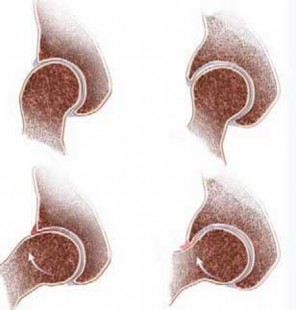 FAI: Impingement and Surgical Dislocation Explained