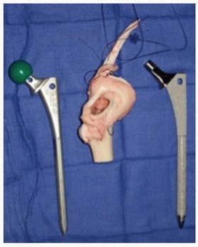 Illustration 6 for Allograft Prosthetic Composite: Mastering Proximal Femur Reconstruction