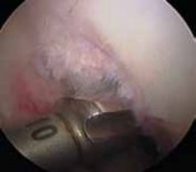 Illustration 12 for Cruciate Ligament Repair: Definitive Guide to Treatment & Recovery