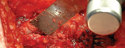 Illustration 12 for Femoral Stem Revision: Posterior Approach for Better Outcomes