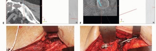 Illustration 53 for Sacral Tumor Surgery: Safeguarding Bowel & Bladder Control