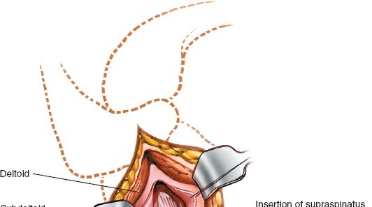 Illustration 107 for Essential Guide: Mastering Every Approach to the Shoulder