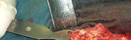 Illustration 21 for Optimizing Infected THA: The One Staged Approach Explained