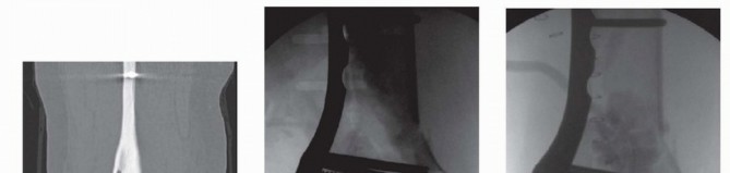 Illustration 59 for Repairing Distal Femur Fractures: Open Reduction & Internal Fixation