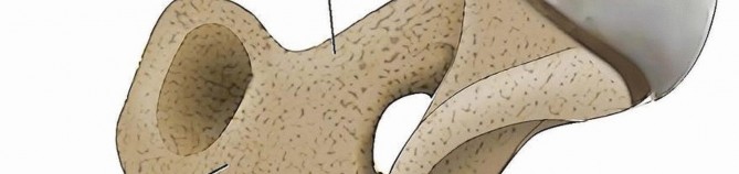 Illustration 5 for Achieve Optimal Femoral Head Fixation with Cephalomedullary Nailing