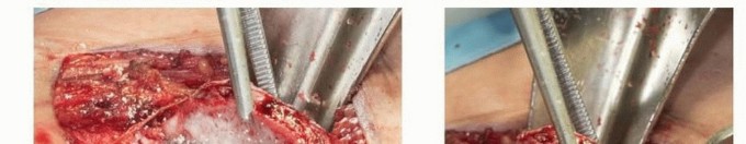 Salter Innominate Osteotomy: Correcting Developmental Hip Dysplasia