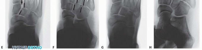 Illustration 7 for Fixation of Lisfranc Injuries: Essential Open Reduction Guide