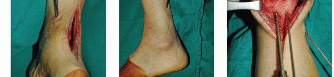 Illustration 21 for Optimize Pain Management with Proximal Ring Block for Ankle Arthrodesis