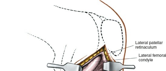 Illustration 139 for Mastering Knee Approaches: Spotlight on Superficial Medial Ligament