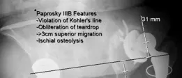 صورة توضيحية لـ استبدال مفصل الورك المراجع: علاج فقدان العظم الشديد وعيوب بابروسكي المعقدة