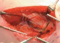 Illustration 11 for Increased Femoral Anteversion: A Proximal Femoral Rotational Osteotomy