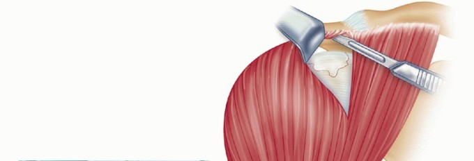 Illustration 9 for Subscapularis & Teres Rotator Cuff Repair: Advanced Techniques