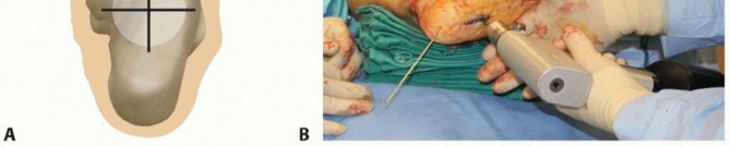 Illustration 31 for Unlock Stability: Medullary Nail Fixation for Tibiotalocalcaneal Arthrodesis