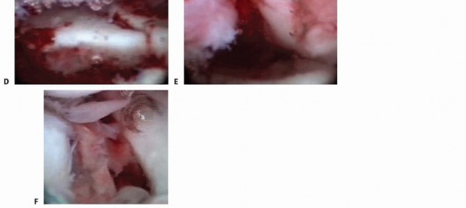 Illustration 9 for Arthroscopic Fixation: Effectively Treating Radial Styloid Fragments
