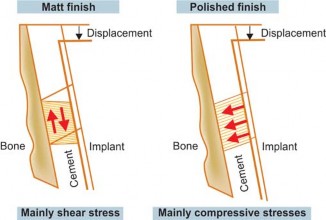 Illustration 36 for Mastering Hip Arthroplasty: Its Evolution and Design Unveiled