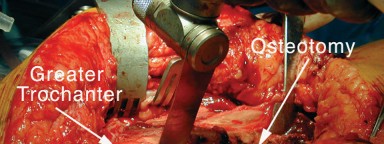 Illustration 18 for Achieving Success with Trochanteric Osteotomy Posterior for Revision