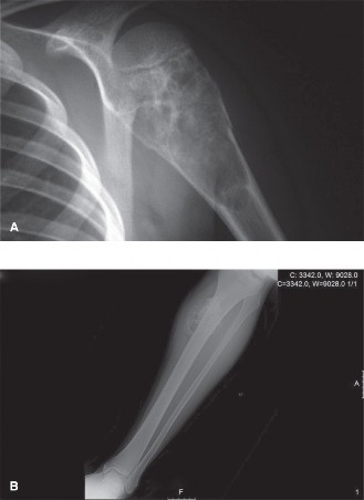 Illustration of ubc from aneurysmal - Dr. Mohammed Hutaif