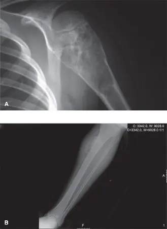 أكياس العظام الأحادية والتمددية: دليل شامل للتشخيص والعلاج مع الأستاذ الدكتور محمد هطيف في صنعاء