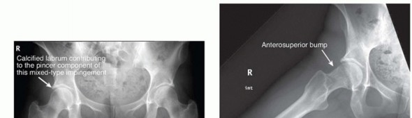 Illustration 2 for Anterior FAI Relief: Mini-Open Anterior Approach Explained