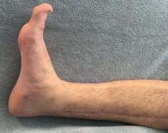 Illustration 25 for Complex Tibial Shaft Fracture: Plate Fixation for Plafond Extension