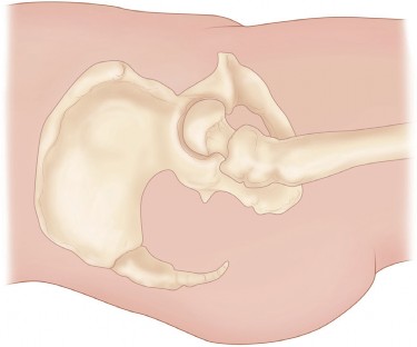 Illustration 32 for Direct Lateral Hip: Optimize Exposure with Sharp Curved Hohmann