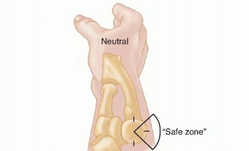 Illustration 23 for Restore Stability & Motion: Fixation of Fracture-Dislocations