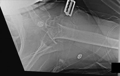 Illustration 210 for OrthoCash: Trauma MCQs & Cases for a yearold woman