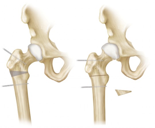 Illustration 11 for Intertrochanteric Femoral Osteotomy: Indications for Hip Preservation