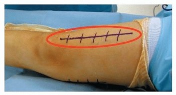 Illustration 5 for Rectus Femoris Muscle Transfer: Restore Gait & Function