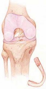 Illustration 76 for Optimizing Single-Bundle Anterior Cruciate Ligament Repair