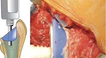 Illustration 28 for Mastering Cementing Technique Femur: A Step-by-Step Guide