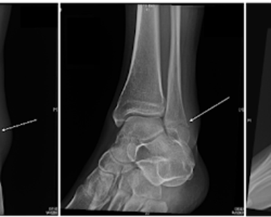 Ankle Fractures Types: Identify Your Break for Effective Recovery