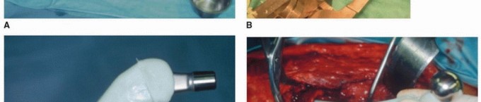 Illustration 5 for PJI of the Hip: Two-Stage Revision: When & How to Prepare