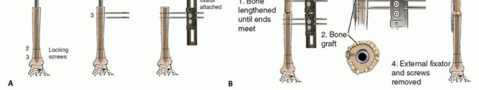 Illustration 18 for Knee Arthrodesis: A Solution for Stable Femur & Tibia Fusion