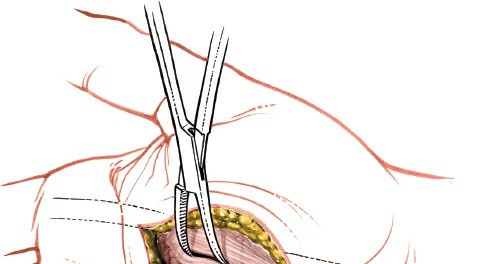 Illustration 232 for Essential Surgical Approaches: Uncover Every Aspect of the Wrist