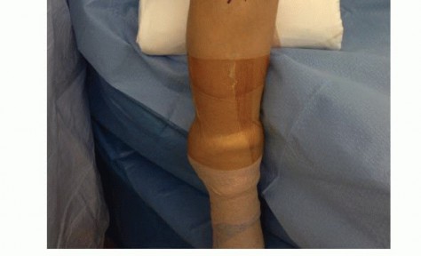 Illustration 10 for Treating Tibial Spine Fractures: Arthroscopy or Open Reduction?