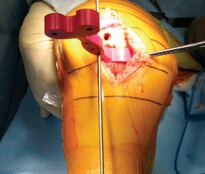 Illustration 15 for Minimally Invasive Subvastus: The Best Path to Quicker TKA Recovery