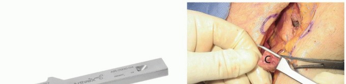 Illustration 22 for Latarjet for Instability: Bone Loss Solutions, Per Burkhart SS, Lo