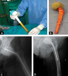 Illustration 8 for Optimizing Outcomes: Two Stage Revision for Infected Total Hip Replacement