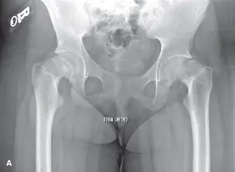 صورة توضيحية لـ الدليل الشامل لانزلاق رأس الفخذ الأعلى (SCFE): الأسباب، التشخيص، والعلاج على يد الأستاذ الدكتور محمد هطيف في صنعاء