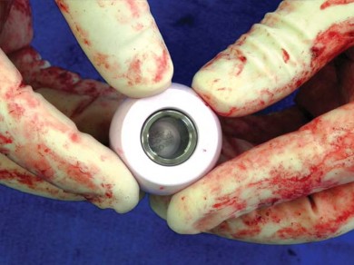 Illustration 55 for Unlock better THA: The technique of short stem for less invasiveness