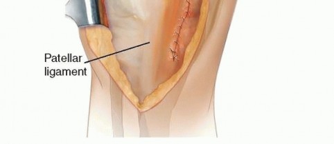 Illustration 4 for Master Extensile Exposure with V-Y Quadricepsplasty