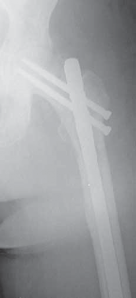 Illustration 20 for Advanced Arthroplasty for Malignant Lesions: Reclaim Your Mobility